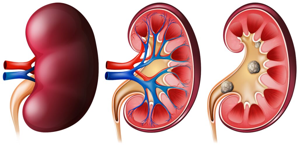 Kidney Failure Treatment in Aurangabad